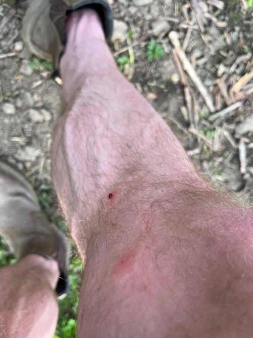 My leg, visible bites, with a small globule of visible blood.